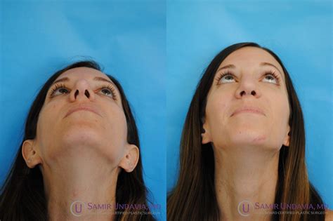 Revision Rhinoplasty | Rhinoplasty, Nose surgery, Septum