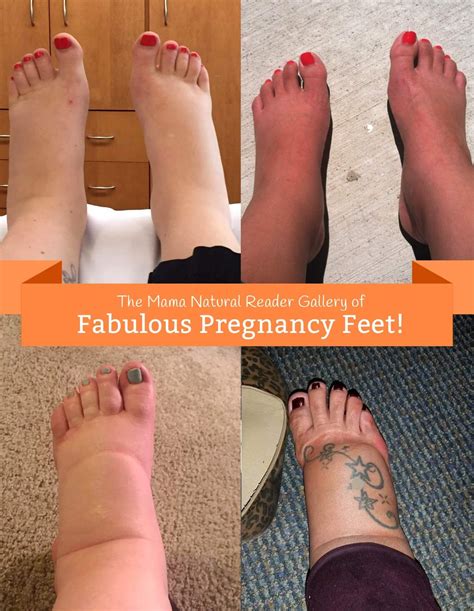 Feet And Ankles Swelling 37 Weeks Pregnant at Kenneth Locke blog
