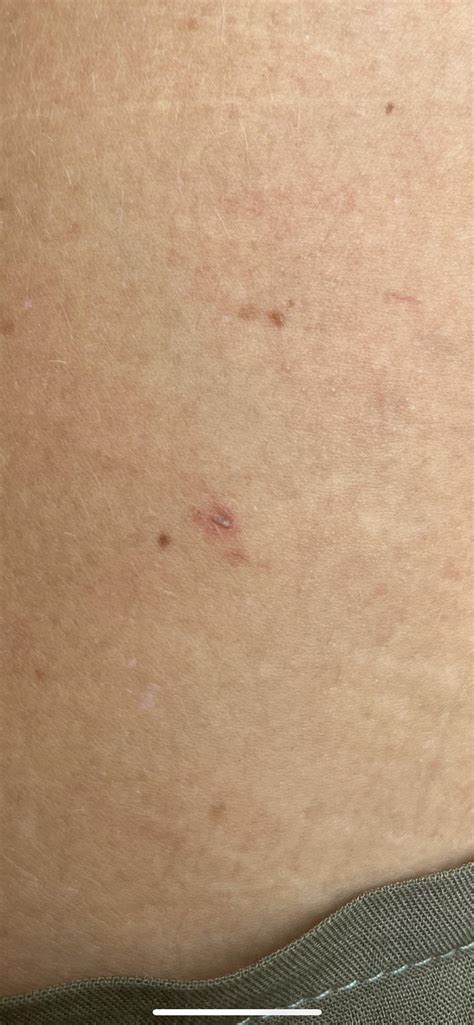 Does this look like melanoma? :( scared : r/Melanoma