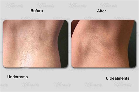 Laser Hair Removal Before And After Bikini Line at Franklyn Kelly blog