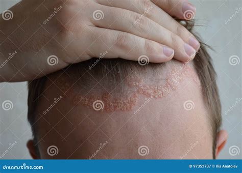 Psoriasis On The Skin Close-up, Scalp, Photos Of Dermatitis And Eczema, Skin Problems ...