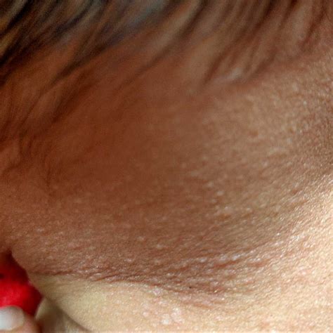 Red Spotty Rash On Baby Neck at Brianna Rocher blog