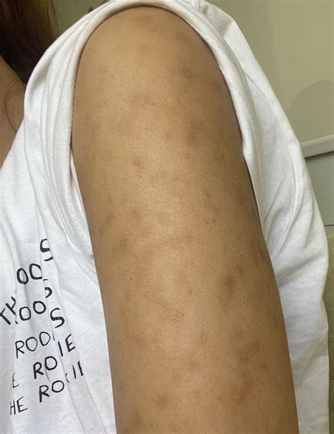 Rash that shows up after fake tanning? : r/DermatologyQuestions