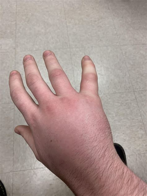 For those wondering how much a centipede sting hurts: here you go : r/centipedes