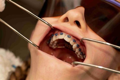 What Is An Expander In Your Mouth at Francis Manley blog