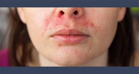Skin Rash #1: Perioral Dermatitis