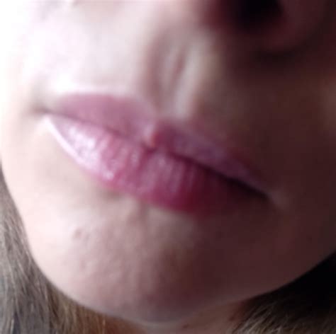 Small painless bump on lip : r/DermatologyQuestions