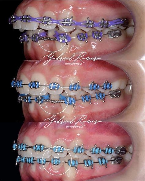 Braces Colors Navy Blue