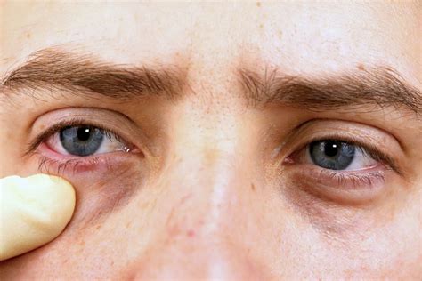 Sunken Eyes / Hollow Eyes - Freyja Medical