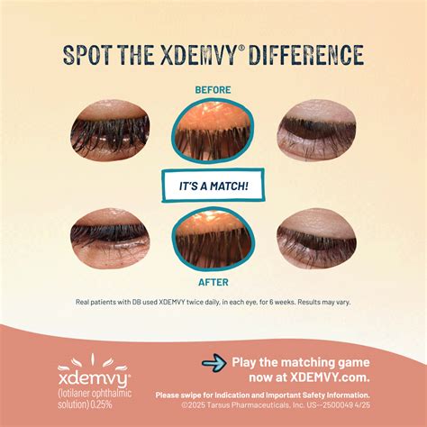 XDEMVY (lotilaner ophthalmic solution) 0.25%