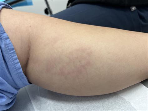 Does anyone else have granuloma annularre? : r/dysautonomia