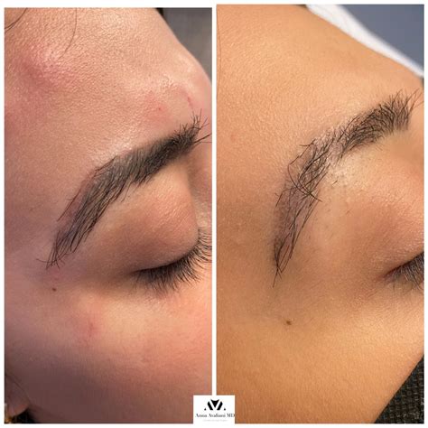 Gallery: Tattoo Eyebrow Removal - Anna Avaliani MD - Cosmetic & Laser Surgery Anna Avaliani MD ...