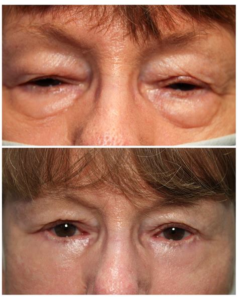 Eyelid Surgery | Pacific Eye Surgeons