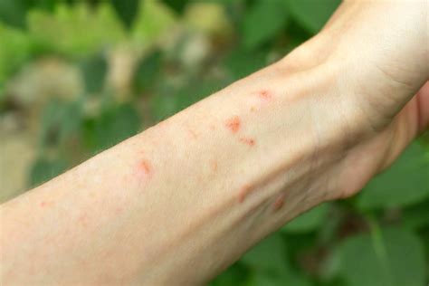 Poison Ivy Rash: Pictures, What to Do, and Prevention