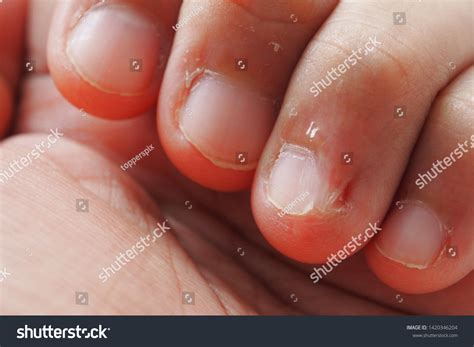 Fingernail Skin Peeling