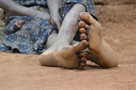 The Tiny Flea Behind a Disease Outbreak in Uganda