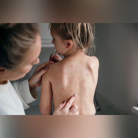 Chicken Pox को भारत में क्यों कहते हैं 'माता'? काफी रोचक है इसका कारण ...