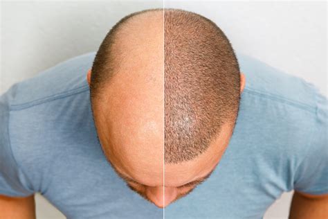 Hair Transplant Timeline Chart - WestModern Clinic