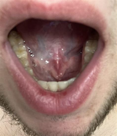 What are these bumps under my tongue? : r/medical_advice