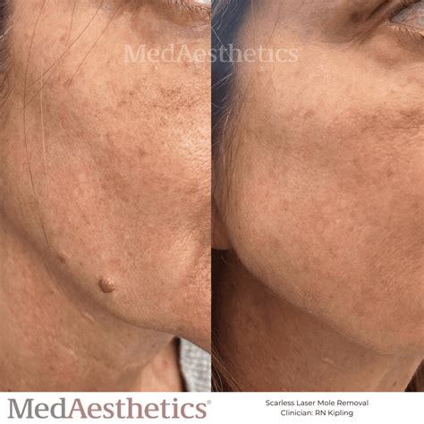 Laser Mole Removal Perth | MedAesthetics