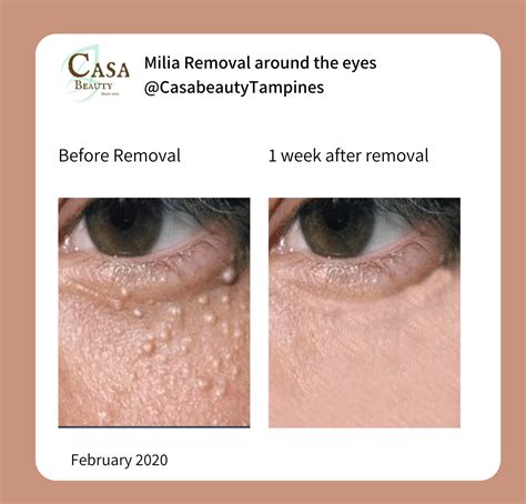 How To Take Off Milia