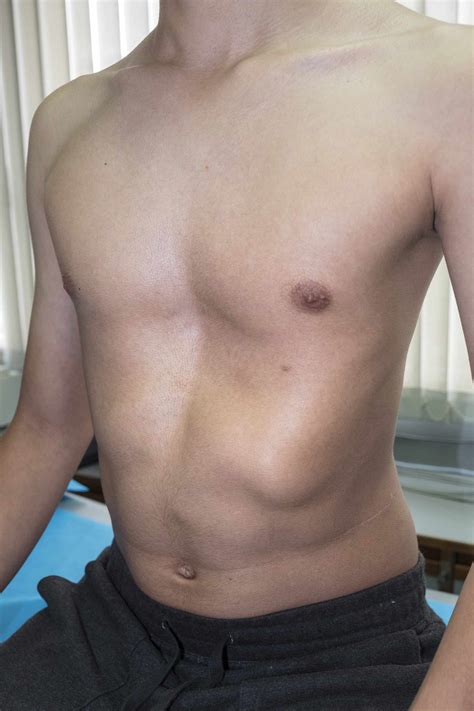 Pectus Excavatum Surgery: Preparation and Recovery