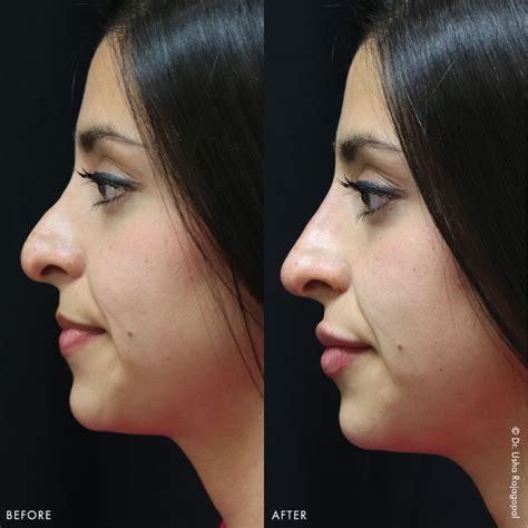 Non Surgical Nose Job Cost