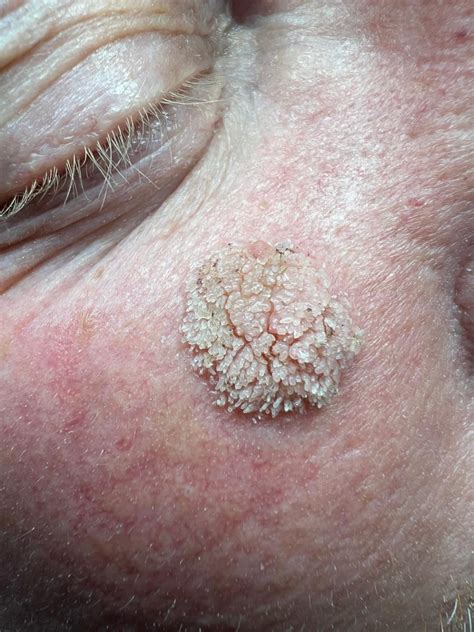 Filiform Wart Before & After