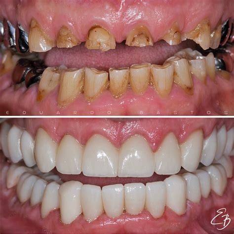 How i healed my teeth naturally fix receding gums cure tooth decay – Artofit