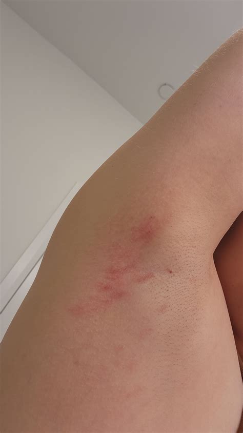 Under arm rash : r/DermatologyQuestions