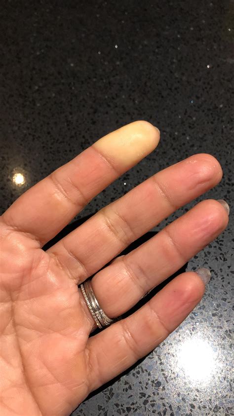 When I get cold, the tip of my index finger goes numb and I just noticed that it looks like this ...