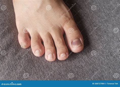 Close Up View of a Toe Nail with Purple Discoloration Due To an Injury. the Bruised Toe Nail is ...