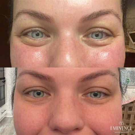 Jelly Roll Eye Treatment at Hazel Phillips blog