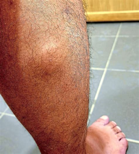 Bitten by a blood-sucking buffalo leech? Here's how you get it off ...