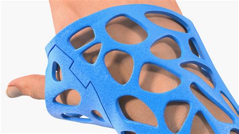 3D-Printed Orthopedic Cast On Hand 3D Model $69 - .3ds .blend .c4d .fbx ...
