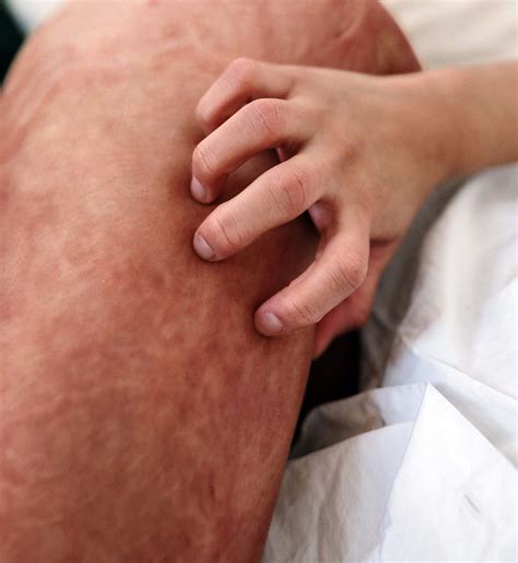 Itch - My Scar Specialist