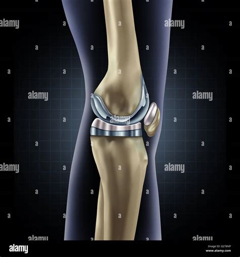Knee replacement implant medical concept as a human leg anatomy after a prosthetic surgery as a ...