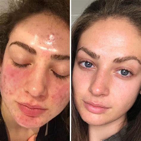 Clearing acne with diet - how does it work? | Emilia Nutrition