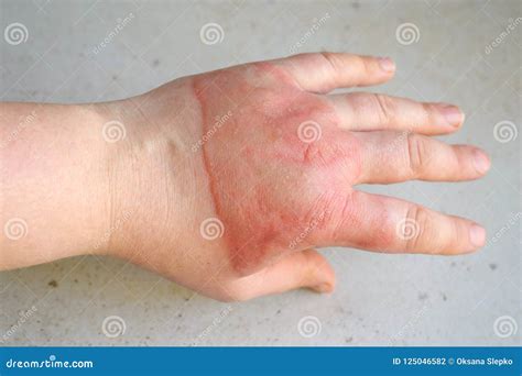 Como Tratar Una Quemadura De Segundo Grado