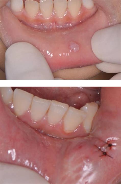 Oral Mucocele Hudlkare P Ntet Laser Mucocele Removal In Pediatric