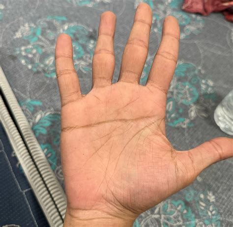 Is this transverse palmar crease? If anyone knows please tell that is ...