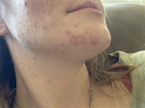 [Skin Concern] 11 weeks pregnant, acne keeps getting worse. Using a ...