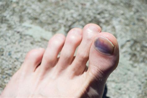 How to Handle a Bruised Toenail | The Chelsea Clinic • Podiatrist • Chiropodist • Independent ...