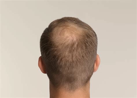 Male Pattern Hair Loss | The Hair Institute | R Clinic