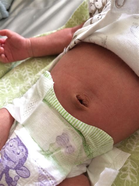 Umbilical Cord Fall Off