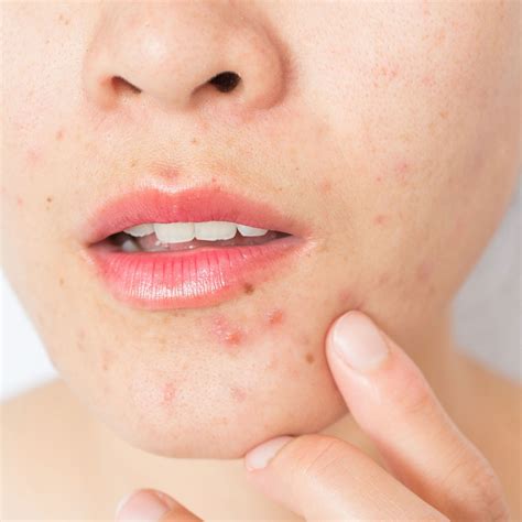 Los beneficios del vinagre de manzana en la piel que no podrás creer | Glamour