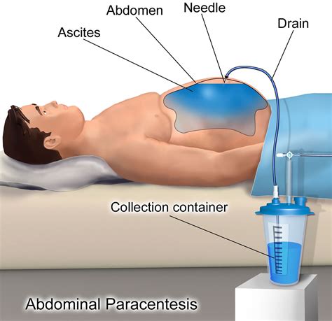 Paracentesis Procedure - Abdominal Paracentesis Position, Complications