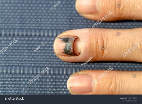 Subungual Hematoma Finger Injury Fingernail Blood Stock Photo ...