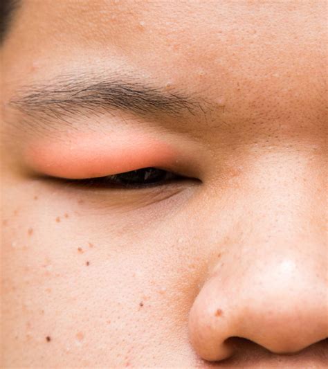 Bug Bite Swollen Eyelid Treatment Fast at Victoria Gregory blog
