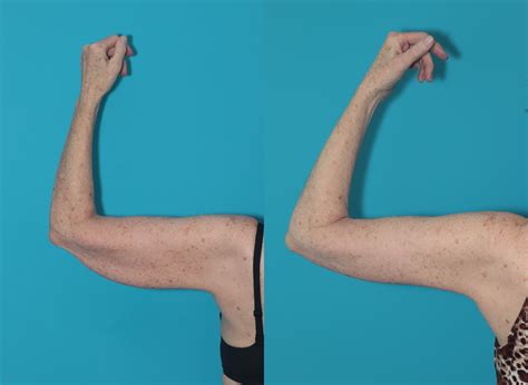 Arm Lift Before and After Pictures Case 324 | West Des Moines & Ames, IA | Koch & Carlisle ...